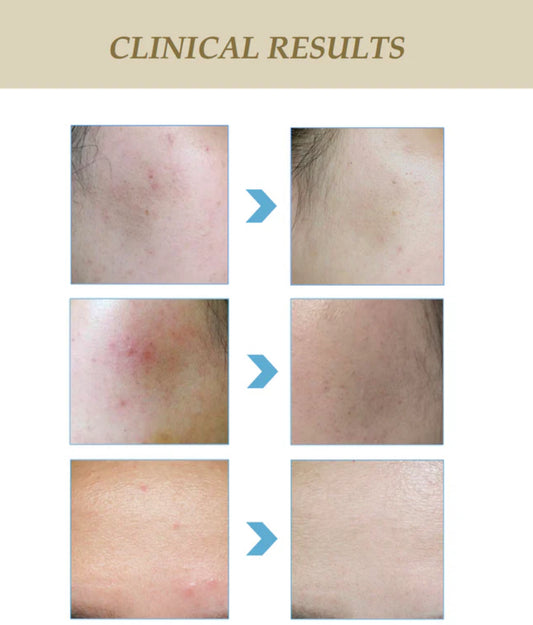 ToniSure Plasma & Galvanic